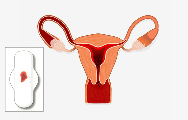 am-dao-chay-mau-bat-thuong Chảy máu âm đạo bất thường là một trong những dấu hiệu cho thấy tình trạng lưu thai tháng thứ 4