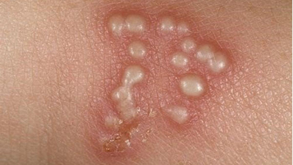 Bẹnh sùi mào gà ở nữ