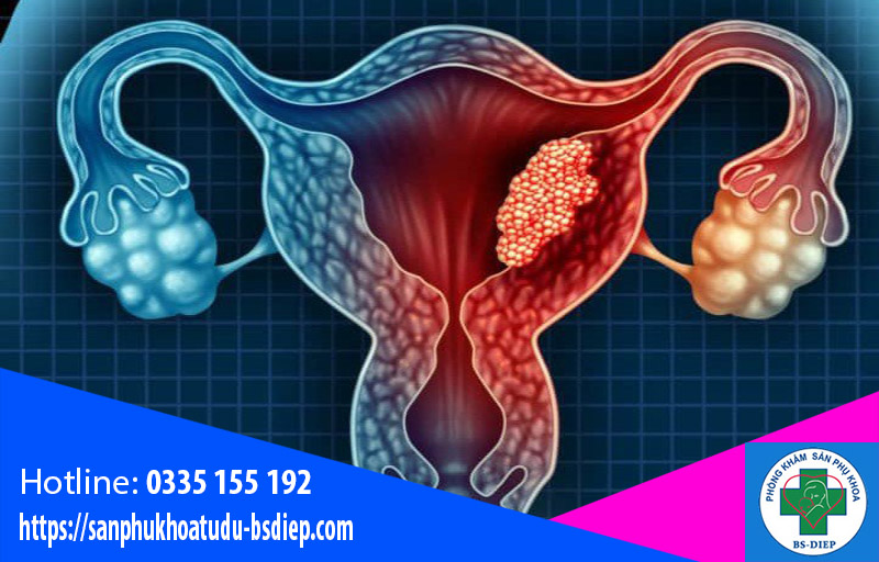 Biến chứng u nang buồng trứng trái