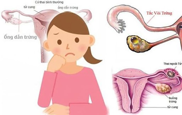 Lạc nội mạc tử cung gây tắc nghẽn đường đi của trứng dẫn đến khó có thai