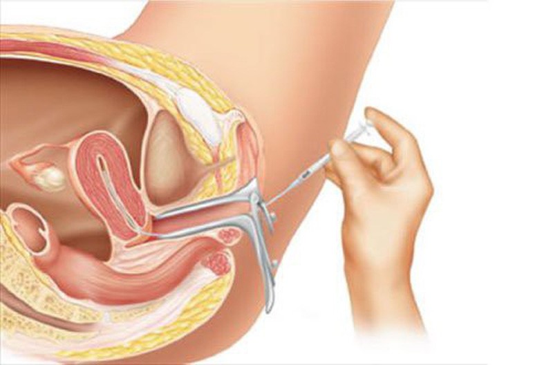 Nguyên nhân khiến bơm tinh trùng không thành công