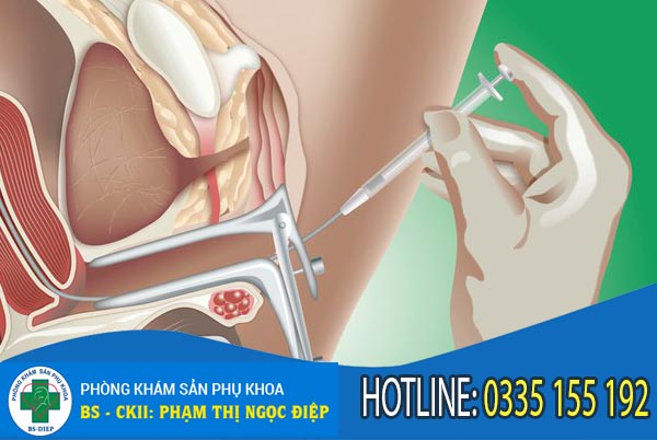 Bơm tinh trùng bào tử cung