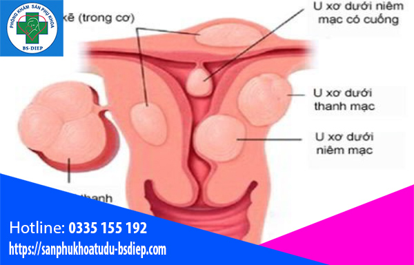 Các loại nhân xơ tử cung