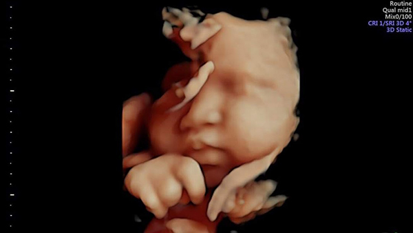 cac-loai-sieu-am-5d "Có