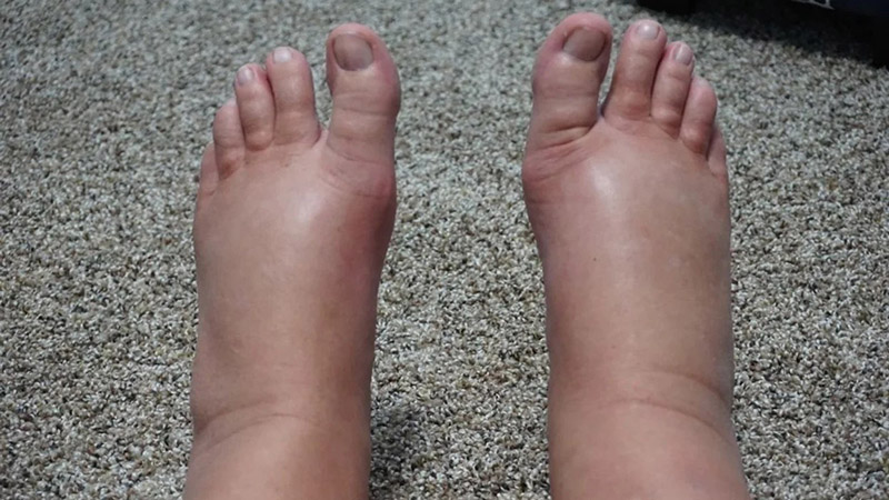 cach-giam-phu-chan-cho-ba-bau Cách giảm phù chân cho bà bầu