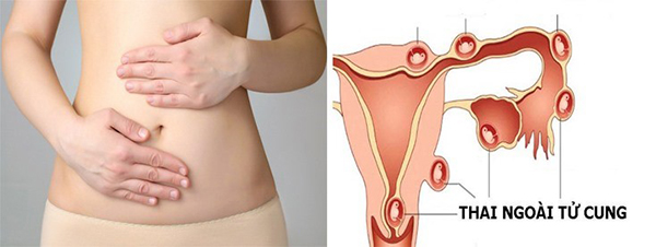 can-than-khi-mang-thai-ngoai-tu-cung Cẩn thận khi mang thai ngoài tử cung