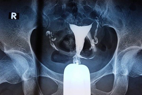 chup-tu-cung-voi-trung Chụp tử cung vòi trứng