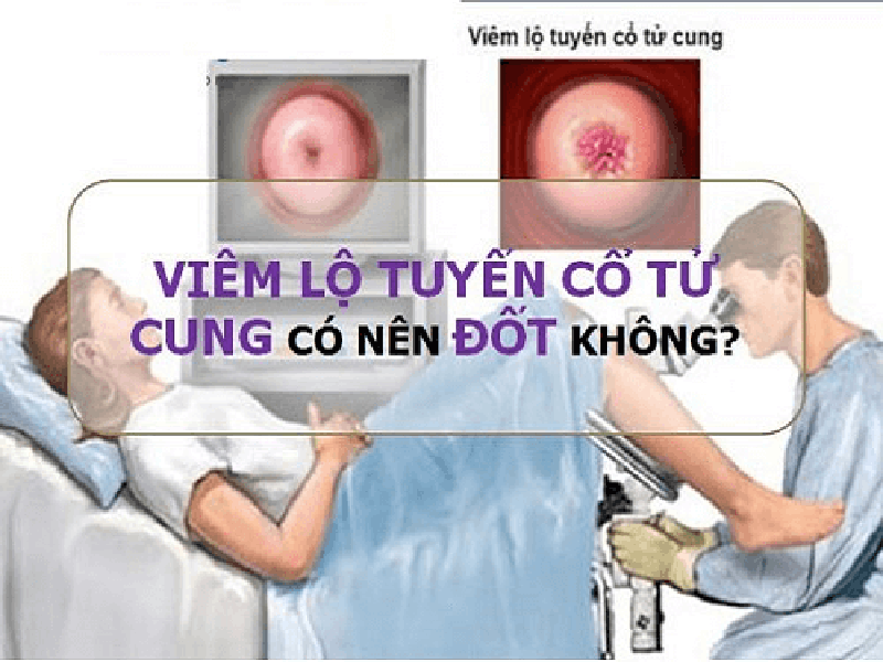 co-nen-dotviem-lo-tuyen-co-tu-cung Có nên đốt viêm lộ tuyến cổ tử cung
