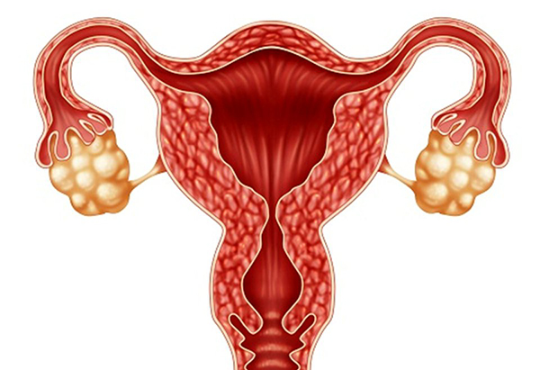 da-nang-buong-trung-co-nguy-hiem-khong Đa nang buồng trứng có nguy hiểm không