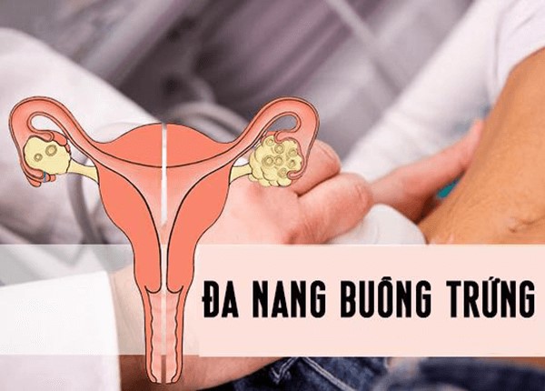 Đa nang buồng trứng gây vô sinh
