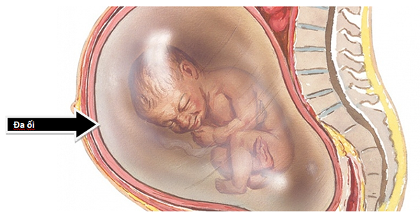 Mẹ đa ối tuần 37 có nguy hiểm gì không?