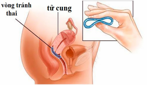 Đặt vòng tránh thái khi nào ở đâu