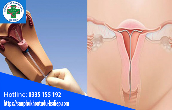 dat-vong-tranh-thai1-4 Đặt vòng tránh thai