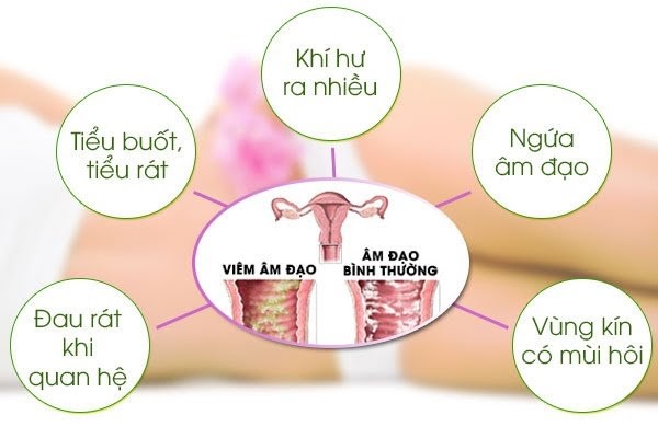 Những dấu hiệu thường gặp khi bị bệnh nấm Candida