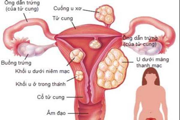 dau-hieu-u-nang-tu-cung-1 Dấu hiệu u nang tử cung
