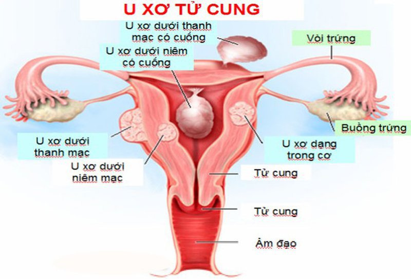 Số lượng u xơ trong tử cung quá nhiều có thể gây nguy hiểm cho người bệnh