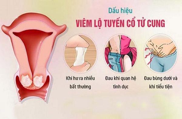 Dấu hiệu viêm lộ tuyến cổ tử cung