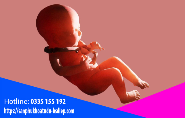 Dây rốn quấn cổ 1 vòng