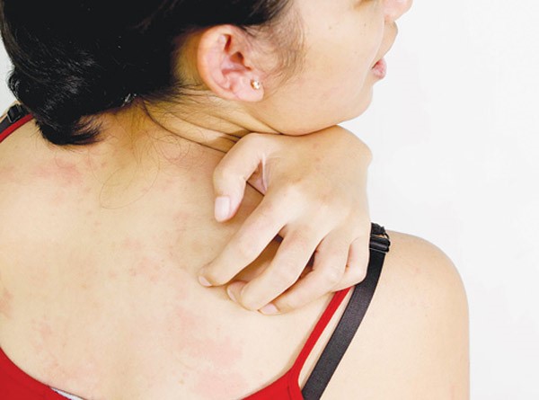 Dị ứng là nguyên nhân chủ yếu khiến mẹ bị nổi mề đay sau sinh
