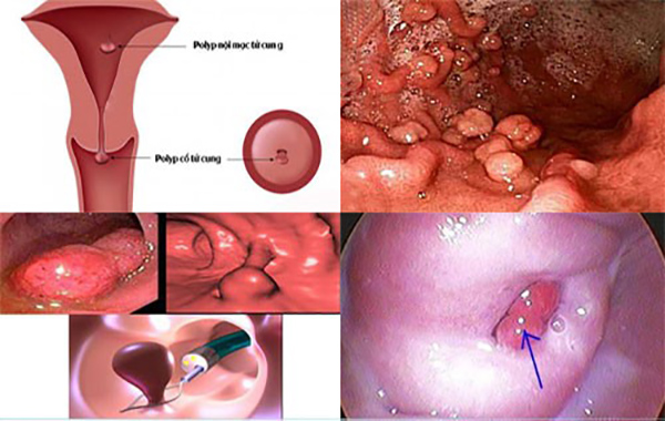 Điều trị polyp cổ tử cung