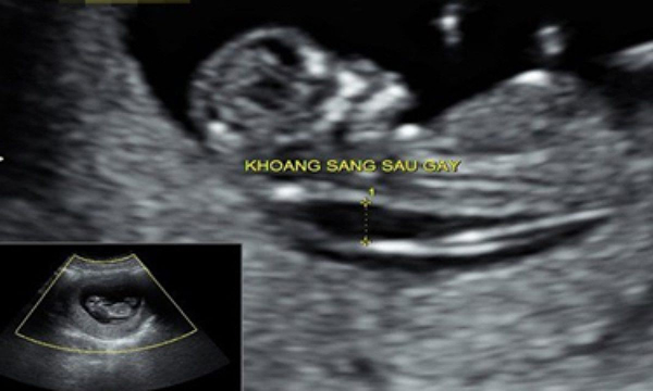 do-mo-da-gay-binh-thuong Độ mờ da gáy bình thường hay không sẽ phản ánh dị tật thai nhi và bệnh Down