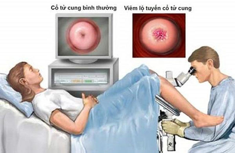dot-viem-lo-tuyen-co-tu-cung Đốt viêm lộ tuyến cổ tử cung