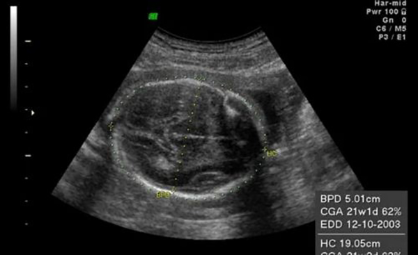 Đường kính lưỡng đỉnh thai 37 tuần