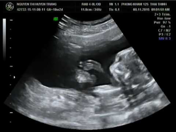 Giảm bức xạ khi siêu âm