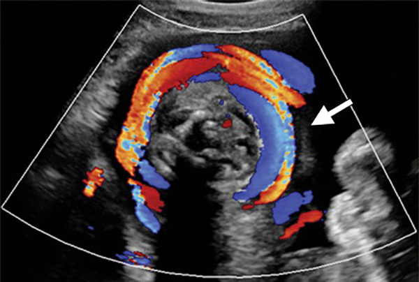 Hình ảnh siêu âm dây rốn quấn cổ