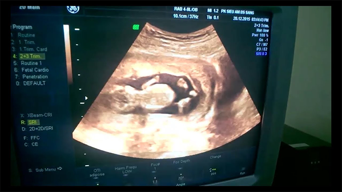 hinh-anh-thai-12-tuan Thai 12 tuần đã thay đổi và phát triển rất nhiều so với các tuần trước đó