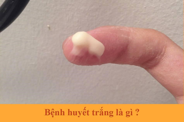 Huyết trắng âm đạo