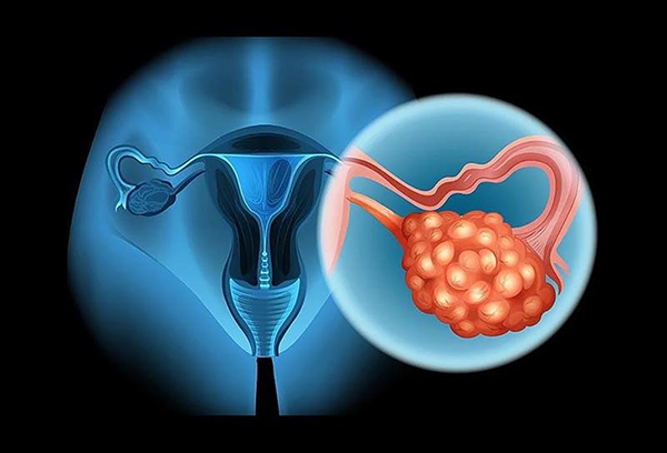 khoi-u-nang-buong-trung-ac-tinh Khối u nang buồng trứng ác tính