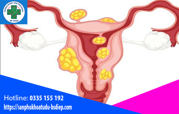 Lích thước nhân xơ tử cung