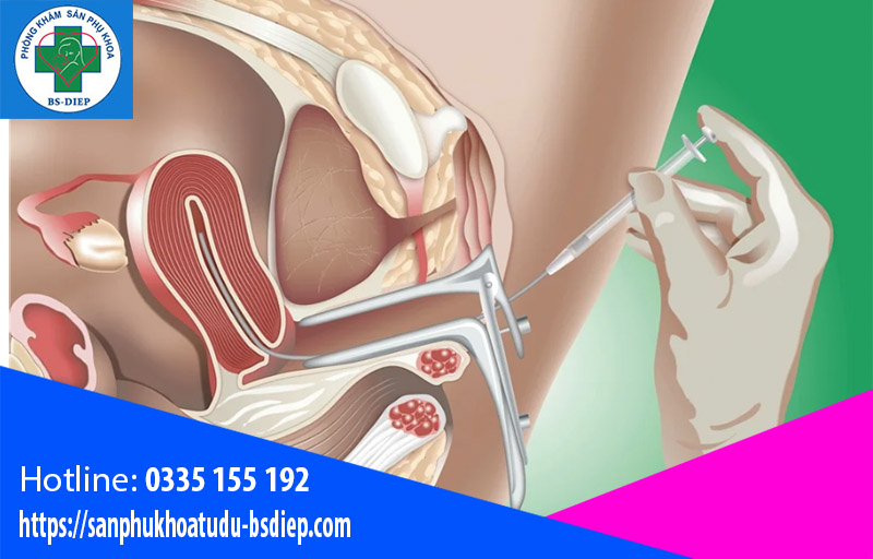 Kinh nghiệm đi bơm tinh trùng