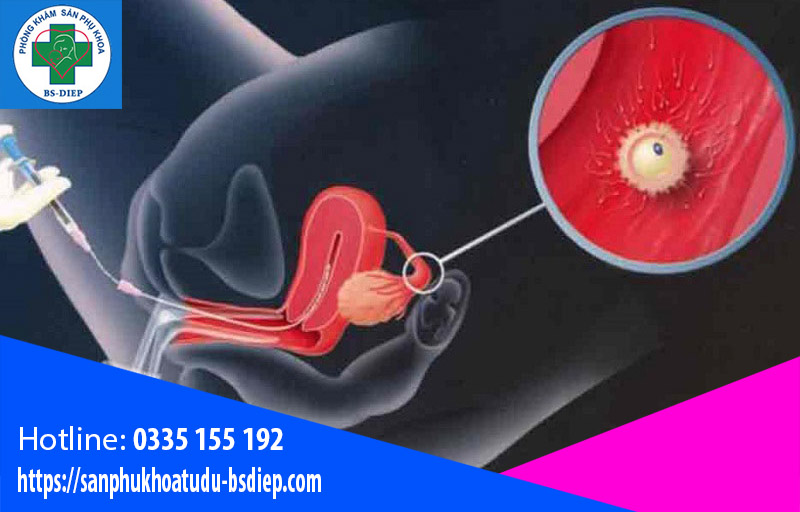 Lưu ý khi bơm tinh trùng