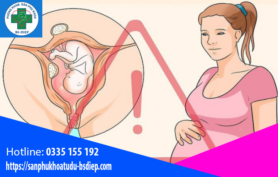 mang-thai-khi-bi-u-xo-tu-cung-1 Mang thai khi bị u xơ tử cung