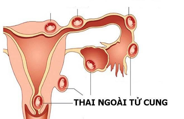 mang-thai-ngoai-tu-cung-1 Mangthai ngoài tử cung