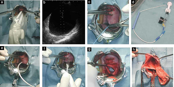 Mổ nội soi u nang buồng trứng