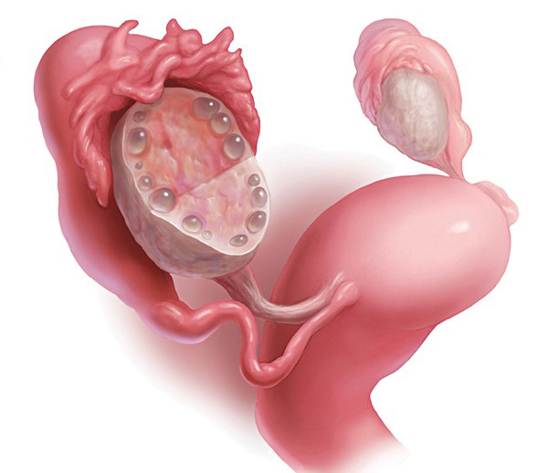 nang-buong-trung Nang buồng trứng