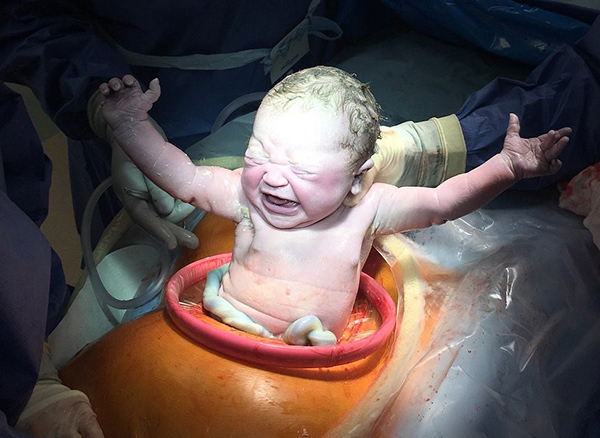 Nên sinh mổ lần 3