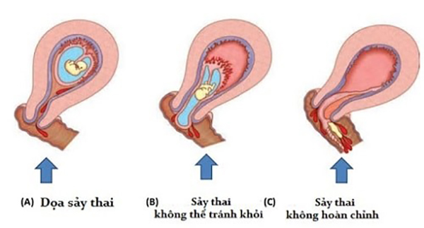 Nguyên nhân gây ra hiện tượng sảy thai