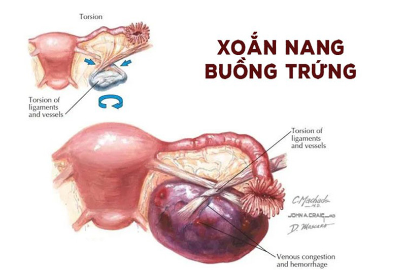 Nguyên nhân oắn nang buồng trứng