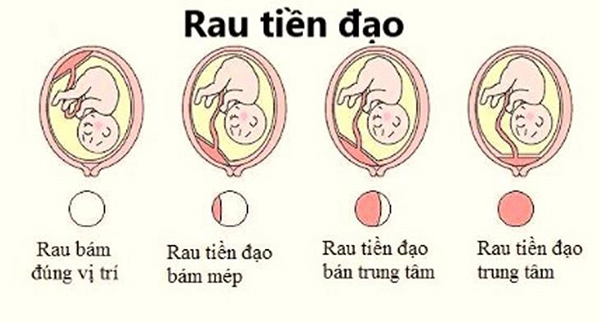 Nhau tiền đạo là tình trạng nguy hiểm mà bà bầu cần lưu ý