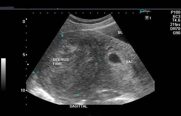 Phát hiện u xơ tử cung qua siêu âm đầu dò