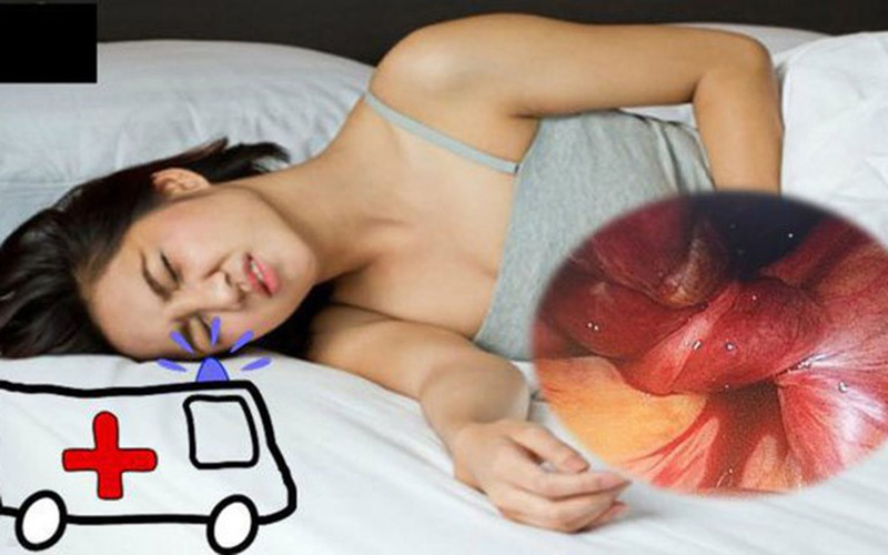 Phòng ngừa nang buồng trứng xoắn