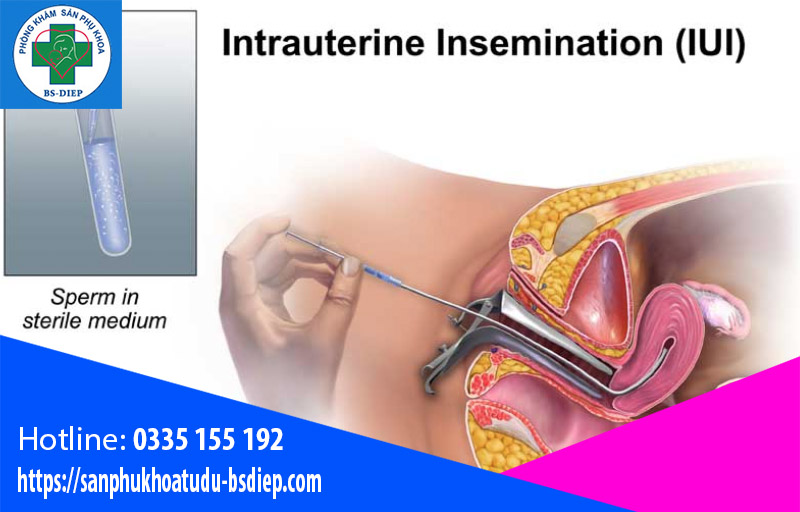 Quy trình bơm tinh trùng