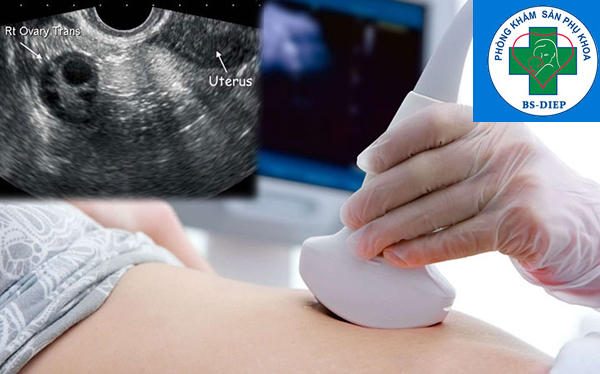 siêu âm buồng trứng