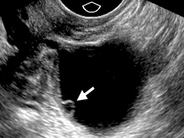 sieu-am-canh-trung Siêu âm canh trứng