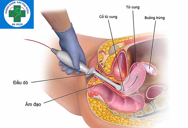 sieu-am-co-tu-cung Siêu âm cổ tử cung