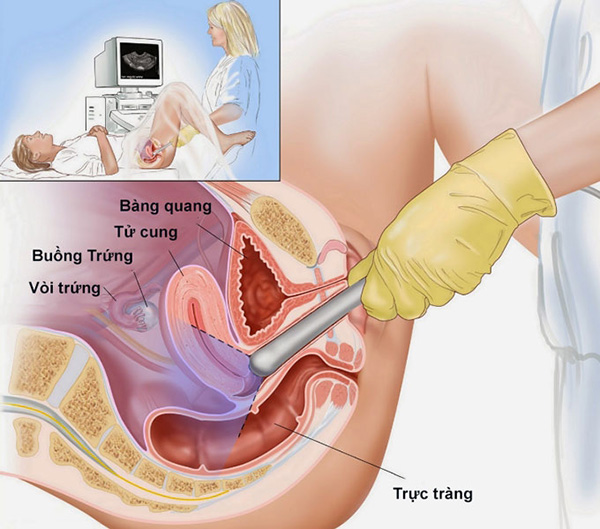 Siêu âm vòi trứng